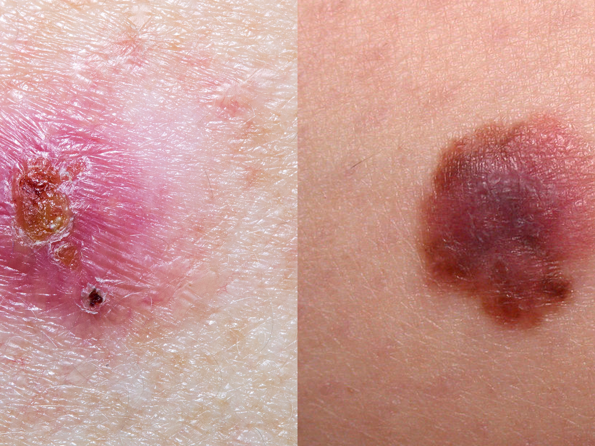 Early signs of skin cancer no one told you about.